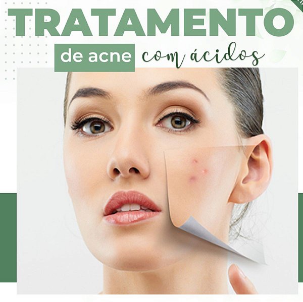 Curso de Tratamento de Acne com Ácidos