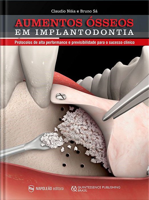 Livro Aumentos Osseos em Implantodontia: Protocolos de Alta Perfomance e Previsiv - Noia/sa