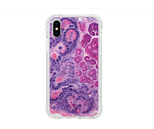 Capa para Celular Histopatologia Tricoblastoma