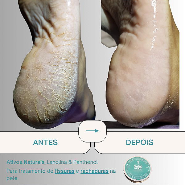 Nanofeet 50g - Creme de Hidratação para Rachaduras