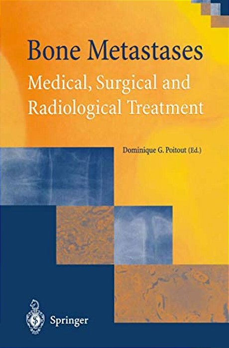 Bone Metastases: Medical, Surgical And Radiological Treatment-..