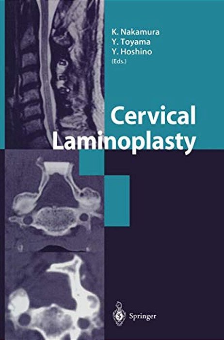 Cervical Laminoplasty-..