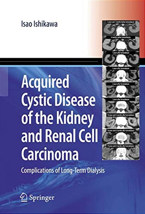 Acquired Cystic Disease Of The Kidney And Renal Cell Carcinoma: Complication Of Long-Term Dialysis-..