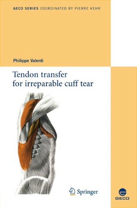 Tendon Transfer For Irreparable Cuff Tear-..