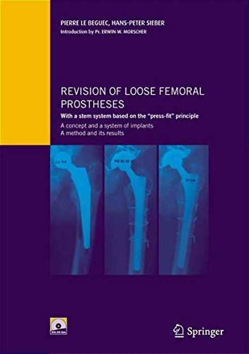 Revision Of Loose Femoral Prostheses With A Stem System Based On The Press-Fit Principle: A Concept And Its System Of Implants, A Method And Its Resul-..