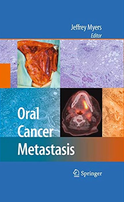 Oral Cancer Metastasis-..