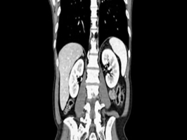 Tomografia de Vias Urinarias