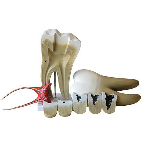 Dente Molar Ampliado com Evolução da Cárie, em 8 Partes