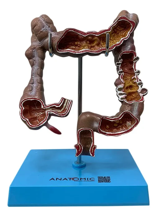 Intestino Grosso com Patologia