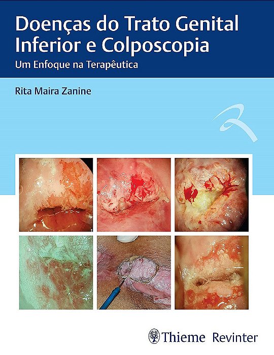 Livro Doenças do Trato Genital Inferior e Colposcopia