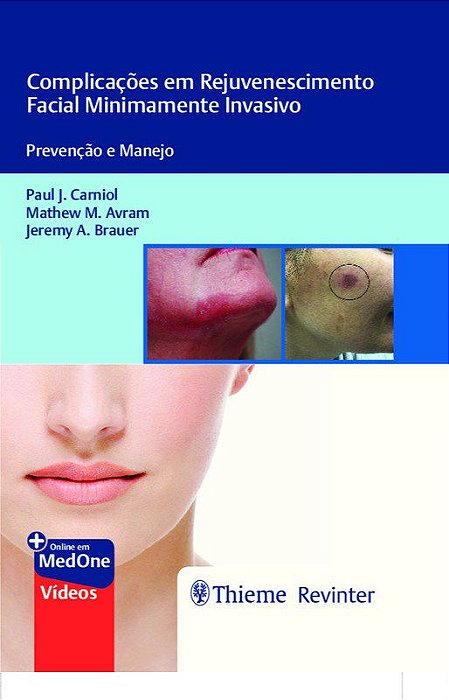 Livro Complicacoes em Rejuvenescimento Facial Minimamente Invasivo: Prevencao e M - Carniol/avram/brauer