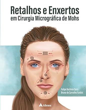 Livro Retalhos e Enxertos em Cirurgia Micrográfica de Mohs - Cerci - Atheneu