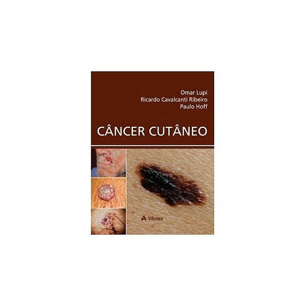 Livro Câncer Cutâneo - Lupi