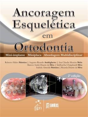 Livro Ancoragem Esquelética em Ortodontia: Mini-implante, Miniplaca
