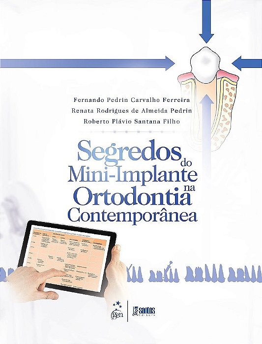 Livro Segredos do Mini-Implante na Ortodontia Contemporânea - Pedrin - Santos