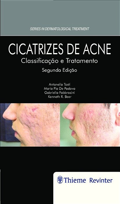 Livro Cicatrizes de Acne - Tosti