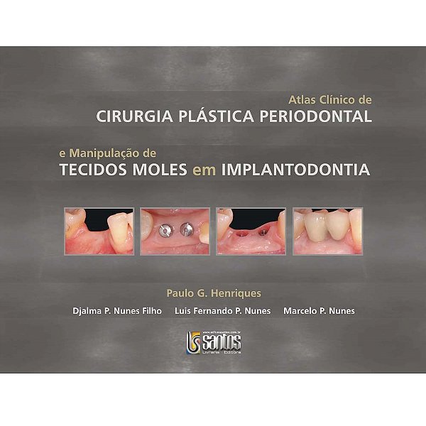 Livro Atlas Clínico de Cirurgia Plástica Periodontal