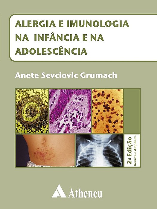 Livro Alergia e Imunologia na Infância e na Adolescência