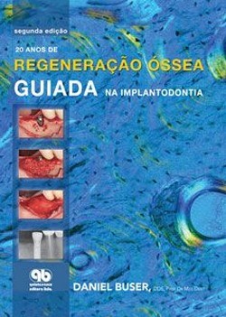 Livro 20 Anos de Regeneração Óssea Guiada Na Implantodontia