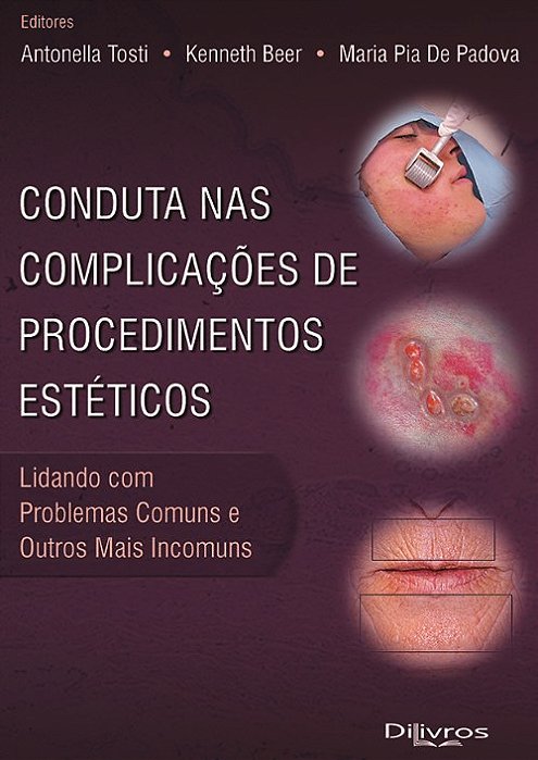 Livro Conduta Nas Complicações de Procedimentos Estéticos  Tosti