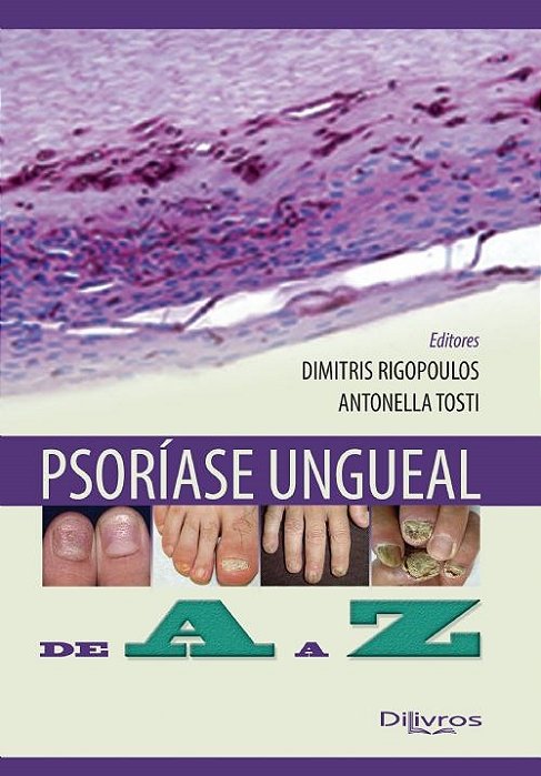 Psoríase Ungueal de a a Z - Rigopoulos - Dilivros