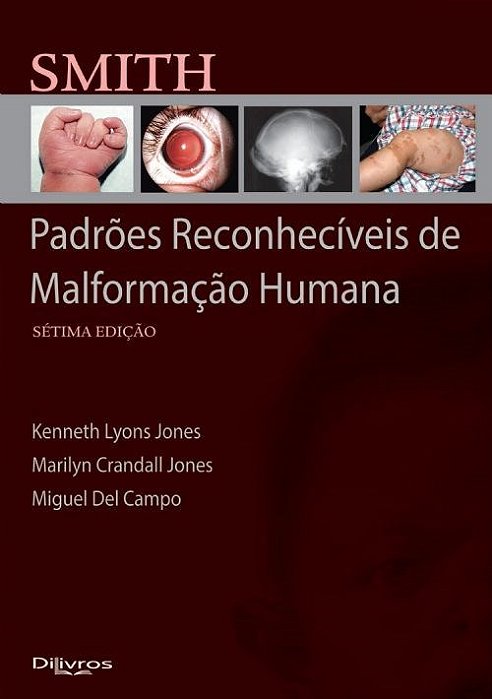 Livro Smith Padrões Reconhecíveis de Malformação Humana