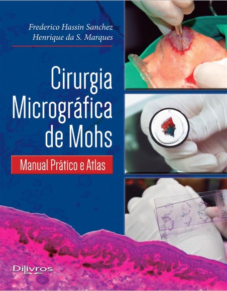Cirurgia Micrográfica de Mohs