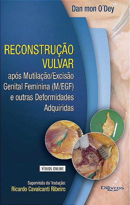 Reconstrução Vulvar com Video - O´dey - Dilivros