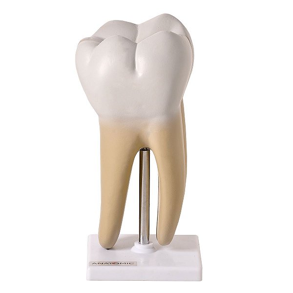 Dente Molar Ampliado Saudável e com Cárie - TGD-0311-B