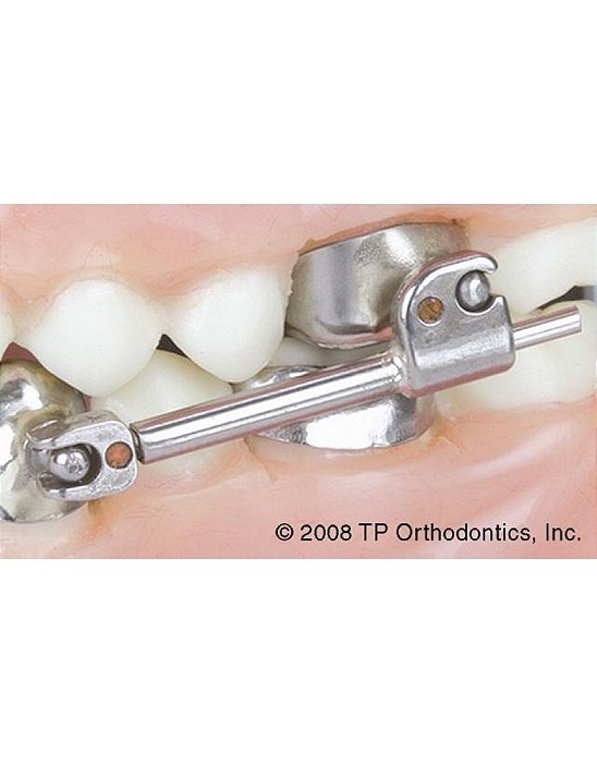 Aparelho Ortodôntico de Avanço Mandibular Flip Lock Herbst Appliance TP Orthodontics