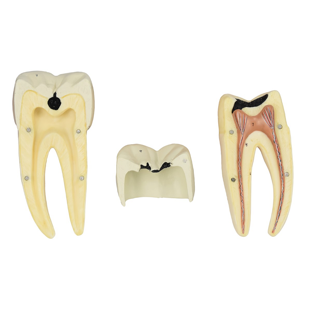 DENTE MOLAR INFERIOR C/ RAIZ DUPLA EM 3 PARTES C/ CÁRIE