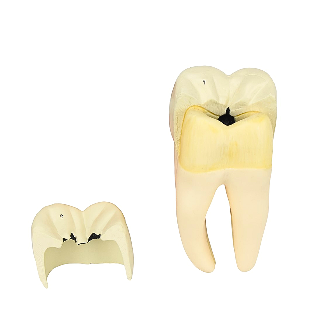 DENTE MOLAR INFERIOR C/ RAIZ DUPLA EM 3 PARTES C/ CÁRIE