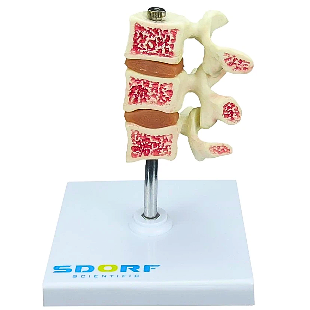 MODELO DE OSTEOPOROSE - SD5200 - SDORF