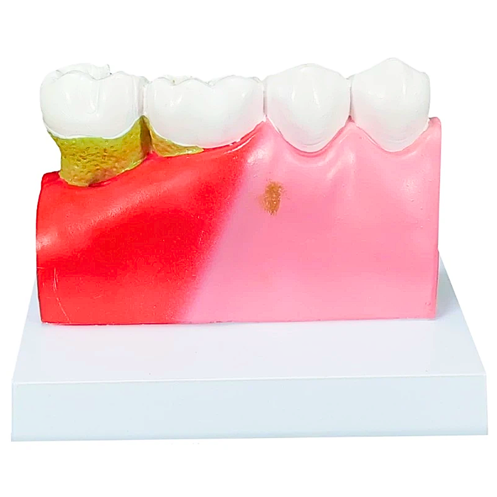 MODELO DE PATOLOGIAS DENTÁRIAS - SD5202 - SDORF
