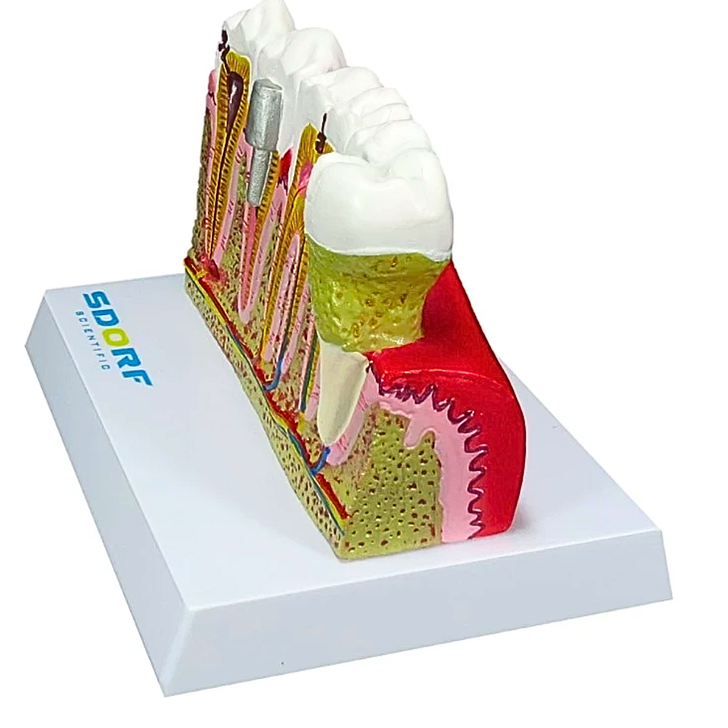 MODELO DE PATOLOGIAS DENTÁRIAS - SD5202 - SDORF