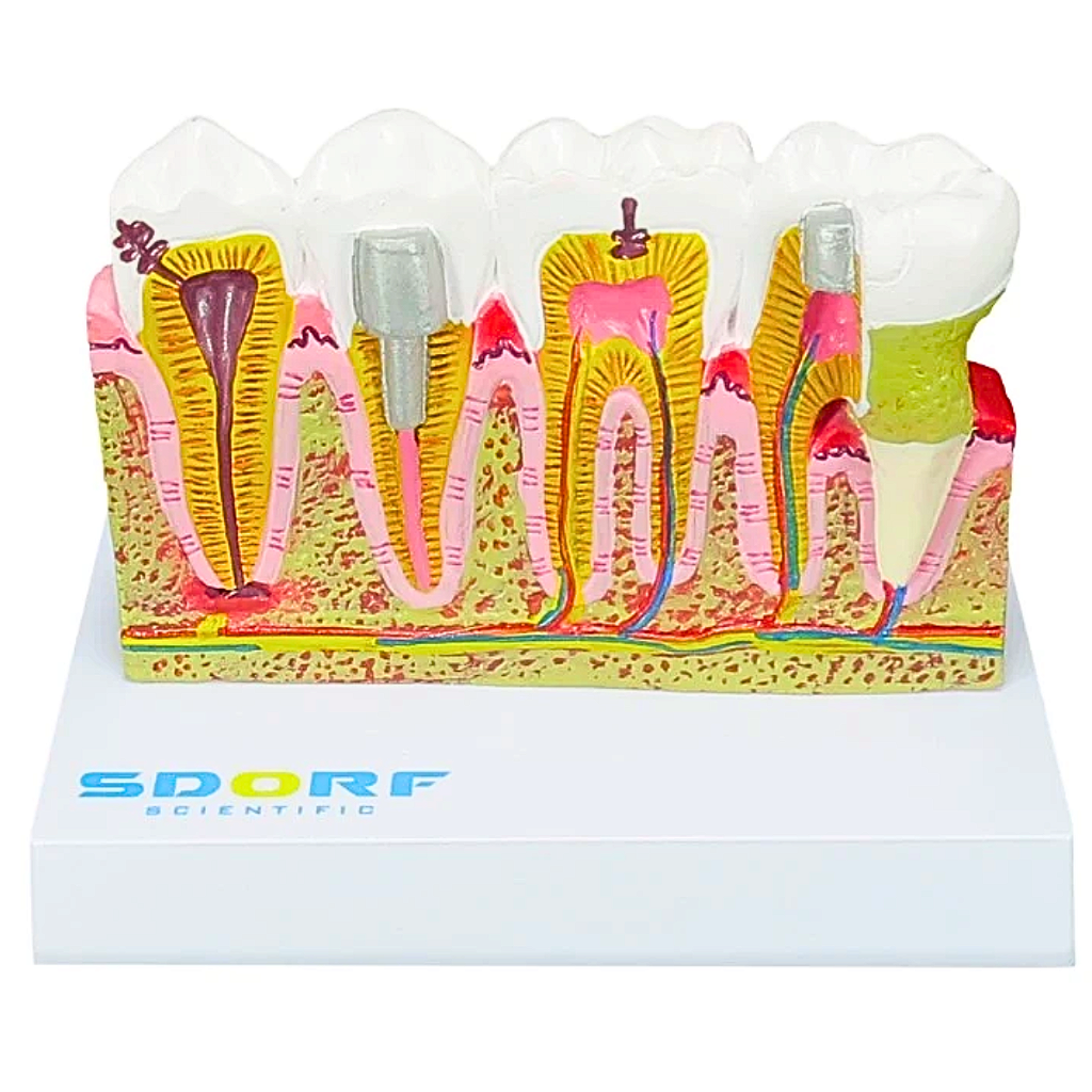 MODELO DE PATOLOGIAS DENTÁRIAS - SD5202 - SDORF