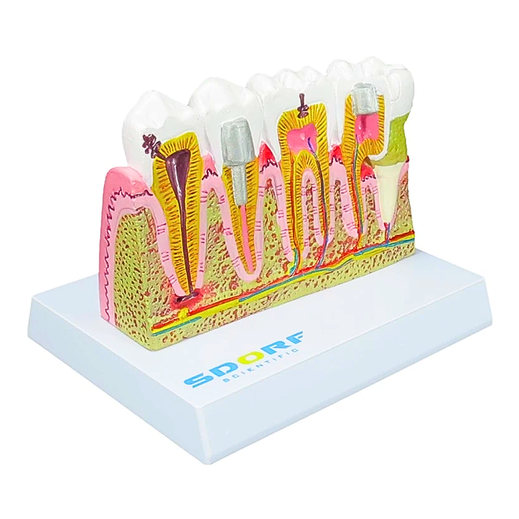 MODELO DE PATOLOGIAS DENTÁRIAS - SD5202 - SDORF
