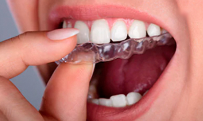 invisalign