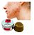 Kit Sabonete E Creme Anti Acne Cravos E Espinhas O Melhor! - Imagem 2