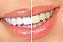 Clareador Dental Original Opalescence PF 15% C/ 4 Seringas - Ultradent - Imagem 3