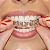 Moldeira para Clareamento Dental - Imagem 5