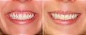 Botox - redução efetiva sorriso gengival - Exponha a gengiva na medida certa. - Imagem 2