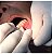Cautermax (cauterizador portátil descartável) (ponta fina) - Imagem 3