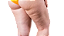 Lipedema (Tratamento Auxiliar) - Imagem 1