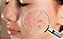 Pi Pa Qing Huang Fei | Acne - 100 cápsulas - Imagem 2