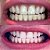 Clareador Dental - Plus White 5 minute - Speed Whitening Gel - Imagem 2