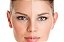 PEELING PARA ESTRIAS COM ACIDO RETINOICO - Imagem 1