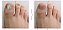 Tratamento das unhas onicomicose sérica paroníquia anti infecção fungo do dedos dos pés e mãos - Imagem 4