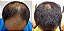 Crescimento Barba e Cabelo - 6 Frascos p 6 Meses - Com Aplicador - Caixa Lacrada - Minoxidil Kirkland - Imagem 2