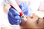 DERMAPEN CANETA MICROAGULHAMENTO | 0.25 a 2.00mm - Imagem 3